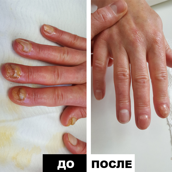 Лечение грибка ногтей